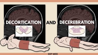 Decerebration vs Decortication  Understanding Neurological Postures amp Brain Damage [upl. by Luna]