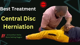 A Central Disc Herniation Is A Rare Condition  Disc Herniation Recovery [upl. by Natalie413]