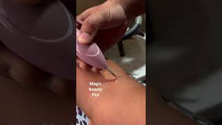 Watch skin tags vanish painlessly with the Veentus Wart Remover Pen Say goodbye to pesky moles [upl. by Aratahs]