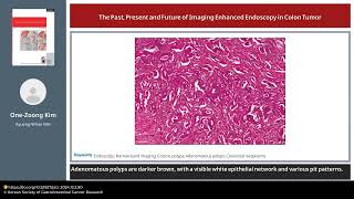 The Past Present and Future of Imaging Enhanced Endoscopy in Colon Tumor [upl. by Addie]