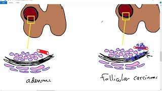 Systemic pathology 30  Endocrine 3  thyroid tumors  DRSAMEH GHAZY [upl. by Nassah]