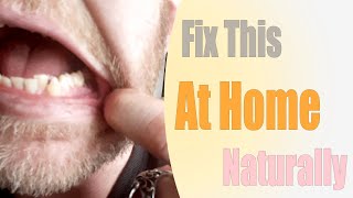 How I fixed my receeding gums at home naturally [upl. by Osbourn]