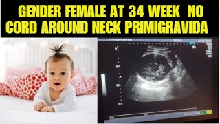 Gender Female At 34 week l No cord around neck l primigravida l 18 years old [upl. by Mathilde856]