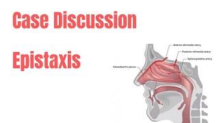 Epistaxis  Case Discussion [upl. by Rotce]