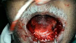 severe peridontitis bleeding management  lower full mouth rehablitation with basal dental implants [upl. by Yesdnyl]