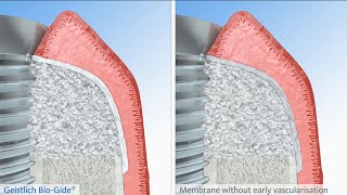 Early Vascularization with Geistlich BioGide® [upl. by Carrel]