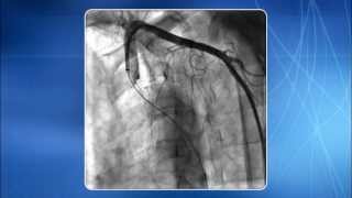 Chapter 5 Subclavian Innominate amp Aortic Arch Regions [upl. by Ardnaek612]