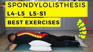 Spondylolisthesis treatment [upl. by Solahcin]