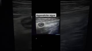 Échographie pelvienne Appendicite aigue non compliqué flowers docteur échographie medical [upl. by Savage518]