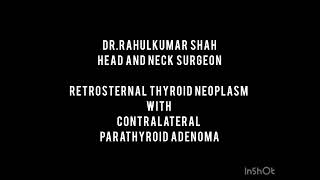 Retrosternal Thyroid Neoplasm With Contralateral Parathyroid Adenoma [upl. by Swinton715]