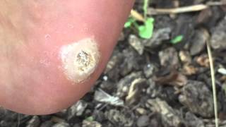 Massive Plantar Wart At home removal attempt [upl. by Ammann696]