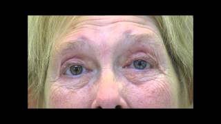 VIMPAT Blepharospasm Hemifacial Spasm Testimonial 2 [upl. by Adrienne]