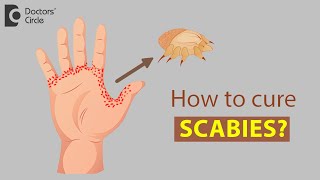 How to cure Scabies  Dr Rajdeep Mysore [upl. by Erasmo]