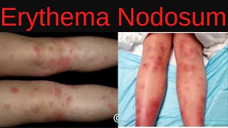 Erythema Nodosum Symptoms Causes Diagnosis Treatment Infections Medications [upl. by Adnah979]