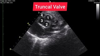 Truncus Arteriosus Echocardiography Compilation [upl. by Aitam204]