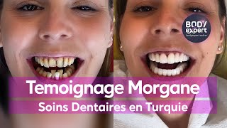 SOINS DENTAIRES  🦷 Témoignage Morgane  6 implants  greffe Os  25 couronnes Emax  BODYEXPERT [upl. by Leith806]