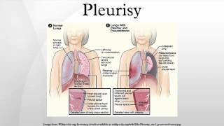 Pleurisy [upl. by Vicky]