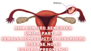 Ectopic pregnancyDisease No12AHNBSN 3rd semesterUnit4 Female reproductive system disorders [upl. by Coffeng370]