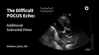 The Difficult POCUS Echo Additional Subcostal Views [upl. by Trueblood]