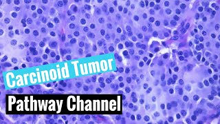 Typical carcinoid tumor of the lung neuroendocrine tumors [upl. by Deina]