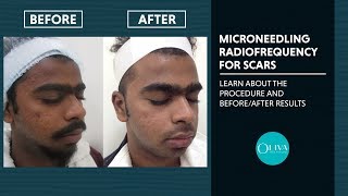 Microneedling RadiofrequencyRF Treatment Before And After Results  Oliva Clinic [upl. by Iinden]