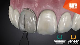 Uveneer® Procedure Animation  Direct Veneer Template System [upl. by Theodor185]