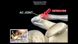 Distal Clavicle Osteolysis  Everything You Need To Know  Dr Nabil Ebraheim [upl. by Janus]