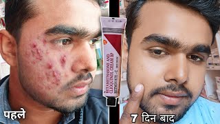 खराब चेहरा को मात्र 7 दिन मे ठीक करे  Betnovate C Cream Honest Review 2022 In Hindi  Betnovate c [upl. by Nnyleimaj]