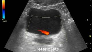 Ureteric jets [upl. by Mortimer]