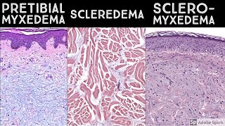 Pretibial Myxedema vs Scleredema vs Scleromyxedema  Dermatopathology quotSoundAlikesquot [upl. by Haymes]