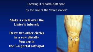 Basic set up and indications for wrist arthroscopy [upl. by Ramyar]