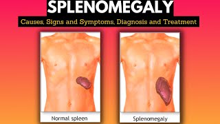 Splenomegaly Causes Signs and Symptoms Diagnosis and Treatment [upl. by Ekul271]