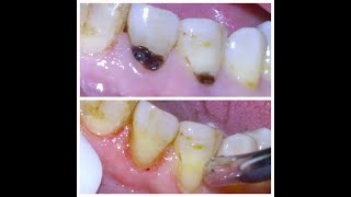 16 Repair of tooth decay at gumline [upl. by Ariday]