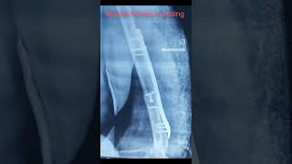 Distal humerus fracture managed with distal humerus plating [upl. by Jacobson767]