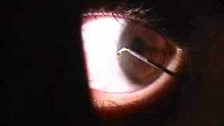 Corneal Foreign Body [upl. by Kcire260]