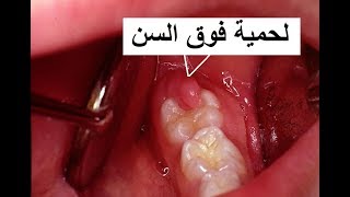 لحمية فوق ضرس العقل الاسباب والعلاج  Pericoronitis [upl. by Nnairak374]