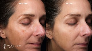 Can you get rid of melasma  Before and Afters [upl. by Erdnassac]