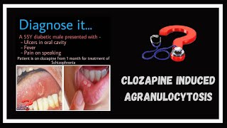 A side effect of clozapine  Agranulocytosis [upl. by Symon863]