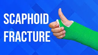 Scaphoid Fractures [upl. by Silber]