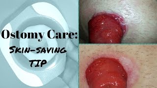 Ostomy care Healing the Skin around the Stoma [upl. by Okubo]