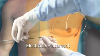 Subcutaneous ICD Animation  Arrhythmiaorg [upl. by Hana]