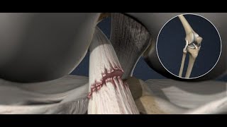 Ligamentos principales de la rodilla y rotura cruzado anterior [upl. by Waldman311]