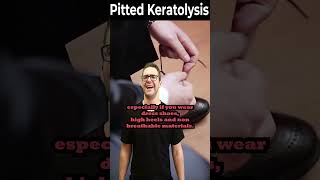 How To Get Rid of Pitted Keratolysis ONCE amp FOR ALL [upl. by Knobloch646]