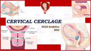 Cervical Cerclage  RCOG Guideline 2022 [upl. by Eniak]