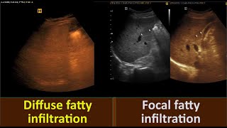 Fatty Liver Grade three  Diffuse Fatty infiltration  Focal fatty sparing [upl. by Nessi]