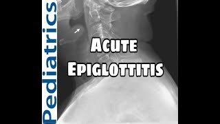 Acute Epiglottitis  Causes  Clinical features  Diagnosis and Treatment MED BABY In HINDI [upl. by Bernadene]