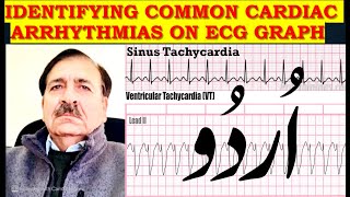 Identifying Common cardiac arrhythmias on ECG graph  Lectures by Dr Alamzeb [upl. by Nyltac601]