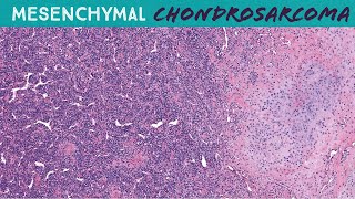 Mesenchymal Chondrosarcoma  round blue cell sarcoma with cartilage amp staghorn vessels UNC case 6 [upl. by Ursas602]