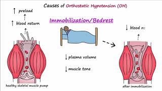 Orthostatic Hypotension Described Concisely [upl. by Ahsaeit]