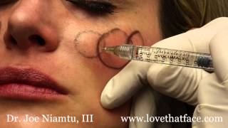 Juverderm Voluma 5 Minute Cheeks by Dr Joe Niamtu III [upl. by Ashleigh413]